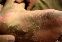 Várices callos y pies agrietados.