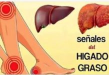 Señales de que tiene el hígado graso.