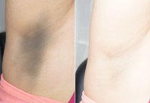 ACLARA TUS AXILAS EN 3 MINUTOS.