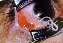 Hay que tener cuidado con lo que comemos! científicos descubren que estas dos comidas crean gusanos capaces de quitarnos la vista y la vida.