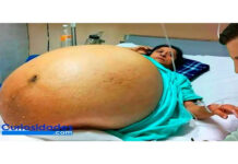 Esta mujer pensaba que estaba embarazada de trillizos. Los médicos no podían creer lo que encontraron.