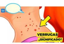 Este es el significado de las verrugas en el cuello.