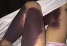 Al despertar, vio a su hija con hematomas en las piernas, cuando sepas el porqué quedarás impactado.